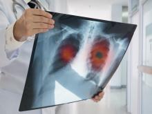 Doctor holding lung scan