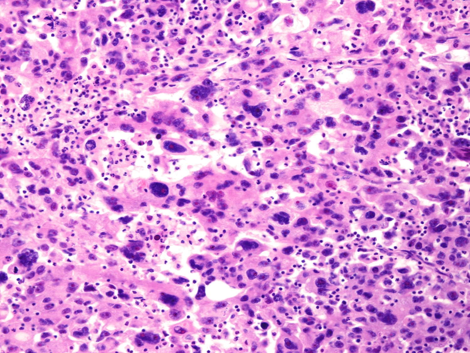 Polyploid Giant Cancer Cells 