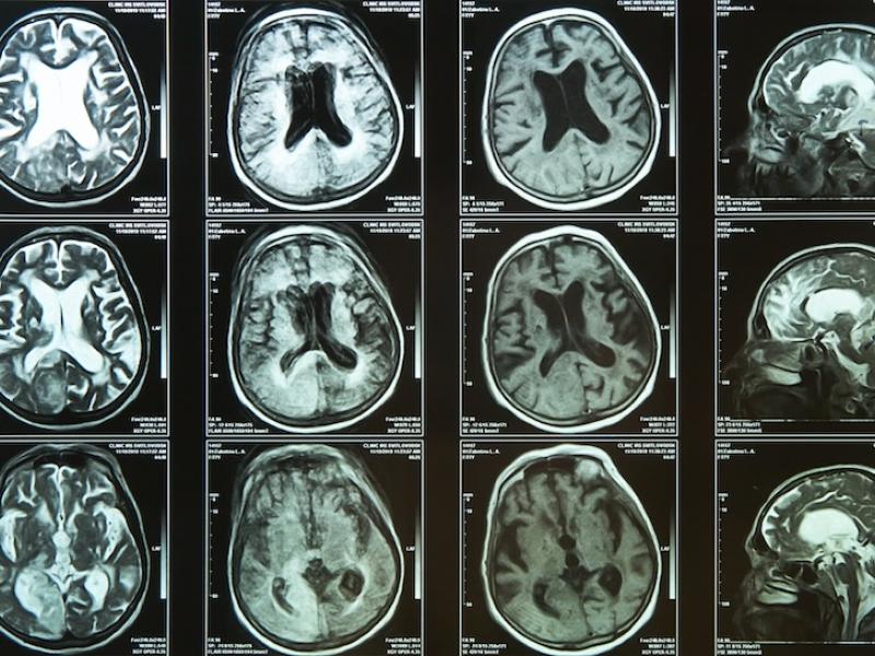 Brain scan of elderly person