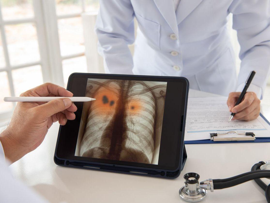Lung inflammation Lung inflammation
