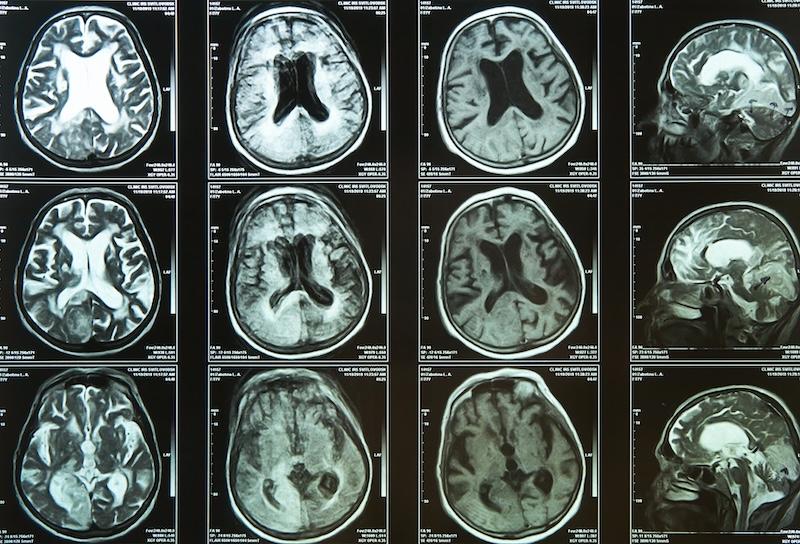 Brain scan of elderly person