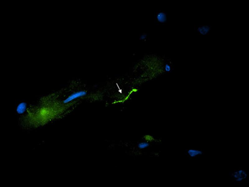 Lyme bacteria in brain tissue