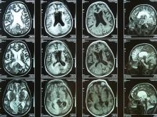 Brain scan of elderly person