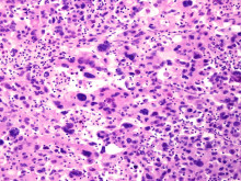 Polyploid Giant Cancer Cells